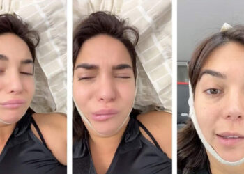 INFLUENCER LUCIANA MILESSI EXPERIMENTA PARÁLISIS FACIAL DESPUÉS DE CIRUGÍA ESTÉTICA
