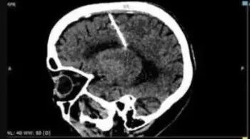 HALLAZGO INSÓLITO: AGUJA OLVIDADA EN EL CEREBRO DE UNA OCTOGENARIA DESVELA IMPACTANTE HISTORIA