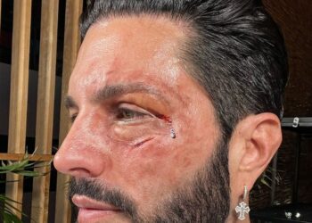 PONCHO DE NIGRIS DESATA LA INCERTIDUMBRE CON UN ENSANGRENTADO ROSTRO; ¿PELEA CON ADAL RAMONES?