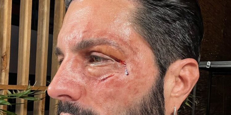 PONCHO DE NIGRIS DESATA LA INCERTIDUMBRE CON UN ENSANGRENTADO ROSTRO; ¿PELEA CON ADAL RAMONES? 1 PONCHO DE NIGRIS DESATA LA INCERTIDUMBRE CON UN ENSANGRENTADO ROSTRO; ¿PELEA CON ADAL RAMONES?