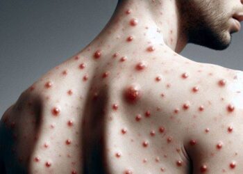 CONFIRMAN CASO IMPORTADO DE SARAMPIÓN EN LA CIUDAD DE MÉXICO