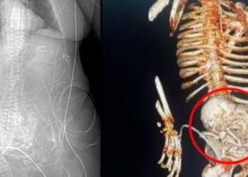 ABUELITA FALLECE TRAS OPERACIÓN PARA REMOVER FETO MOMIFICADO DE MÁS DE 50 AÑOS