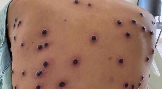 CONFIRMAN CASOS DE VIRUELA DEL MONO EN MORELOS 1 CONFIRMAN CASOS DE VIRUELA DEL MONO EN MORELOS