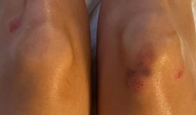 BELINDA COMPARTE FOTOS POST-CAIDA