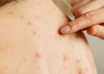 ALERTA NUEVO LEÓN POR BROTE DE SARAMPIÓN EN TEXAS; REGISTRA MÉXICO PRIMEROS CASOS IMPORTADOS