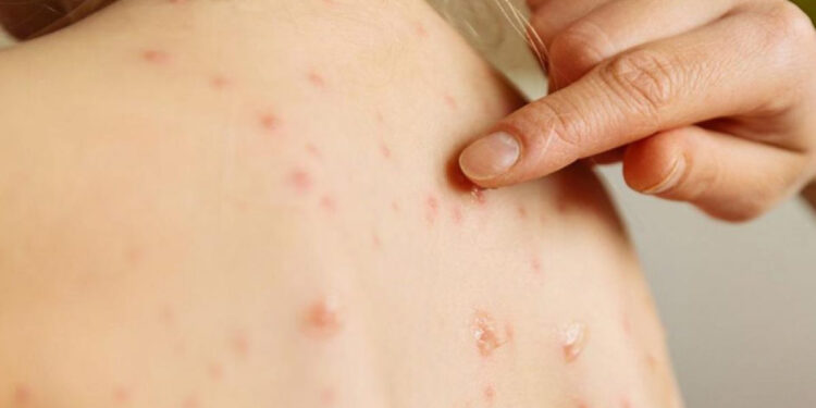 ALERTA NUEVO LEÓN POR BROTE DE SARAMPIÓN EN TEXAS; REGISTRA MÉXICO PRIMEROS CASOS IMPORTADOS 1 ALERTA NUEVO LEÓN POR BROTE DE SARAMPIÓN EN TEXAS; REGISTRA MÉXICO PRIMEROS CASOS IMPORTADOS