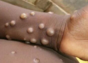 CONFIRMAN PRIMERA MUERTE POR VIRUELA DEL MONO EN JALISCO