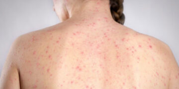 REPORTAN TERCER CASO DE SARAMPIÓN EN NL; CHIHUAHUA ES LA ENTIDAD MÁS AFECTADA CON MÁS DE 4 MIL 500 CONTAGIOS