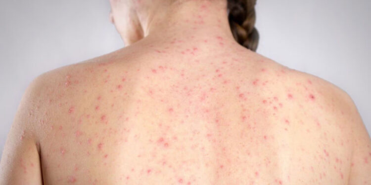 REPORTAN TERCER CASO DE SARAMPIÓN EN NL; CHIHUAHUA ES LA ENTIDAD MÁS AFECTADA CON MÁS DE 4 MIL 500 CONTAGIOS