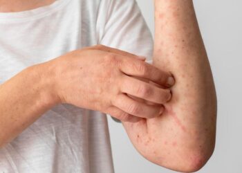 LA OPS EMITE ALERTA EPIDEMIOLÓGICA ANTE EL INCREMENTO CRÍTICO DE CASOS DE SARAMPIÓN EN AMÉRICA