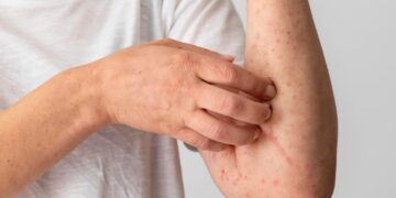 LA OPS EMITE ALERTA EPIDEMIOLÓGICA ANTE EL INCREMENTO CRÍTICO DE CASOS DE SARAMPIÓN EN AMÉRICA