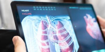 REVOLUCIÓN MÉDICA: DESARROLLAN PRUEBA DE TUBERCULOSIS QUE ELIMINA EL USO DE FLEMA