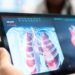 REVOLUCIÓN MÉDICA: DESARROLLAN PRUEBA DE TUBERCULOSIS QUE ELIMINA EL USO DE FLEMA