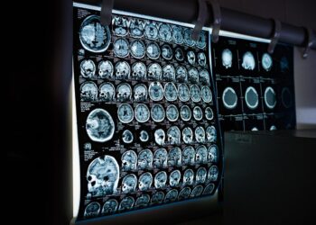 DETECTAN RIESGO NEUROLÓGICO EN 3 NIÑOS DE CENDIS CON ALTOS NIVELES DE PLOMO