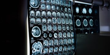 DETECTAN RIESGO NEUROLÓGICO EN 3 NIÑOS DE CENDIS CON ALTOS NIVELES DE PLOMO