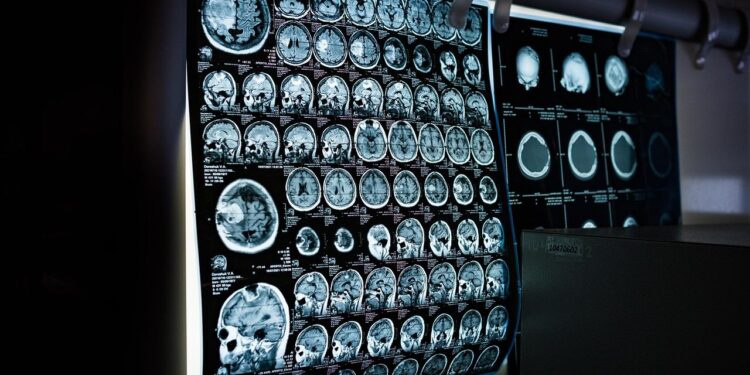 DETECTAN RIESGO NEUROLÓGICO EN 3 NIÑOS DE CENDIS CON ALTOS NIVELES DE PLOMO