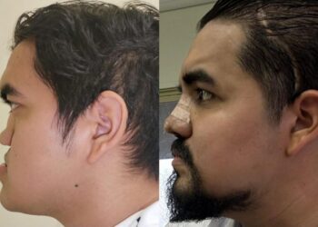 RECONSTRUYE IMSS NL ROSTRO A JOVEN CON TRIPLE CIRUGÍA Y TECNOLOGÍA DE VISUALIZACIÓN 3D