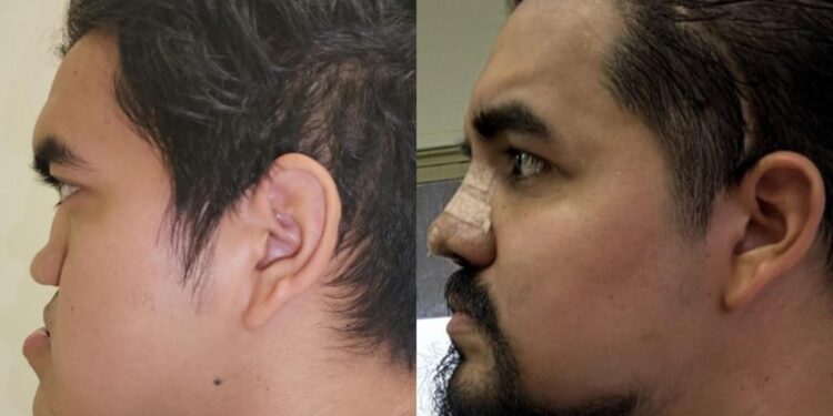 RECONSTRUYE IMSS NL ROSTRO A JOVEN CON TRIPLE CIRUGÍA Y TECNOLOGÍA DE VISUALIZACIÓN 3D 1 RECONSTRUYE IMSS NL ROSTRO A JOVEN CON TRIPLE CIRUGÍA Y TECNOLOGÍA DE VISUALIZACIÓN 3D